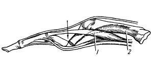 Okrajová zlomenina hlavnej falangy malého prsta.  okrajová zlomenina