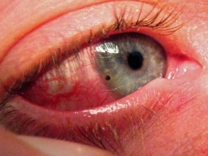 Сильний забій очі гематоми століття що робити.  Що робити при забитому оці