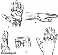 Liečba traumatických amputácií prstov ruky - zásady, odporúčania.  Izolovaná amputácia dvoch prstov penisu